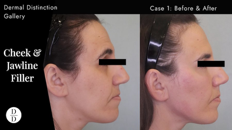 cheekbone enhancement in Balwyn