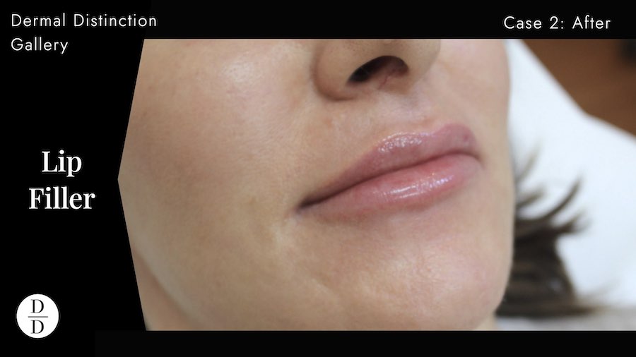 lip filler before and after melbourne