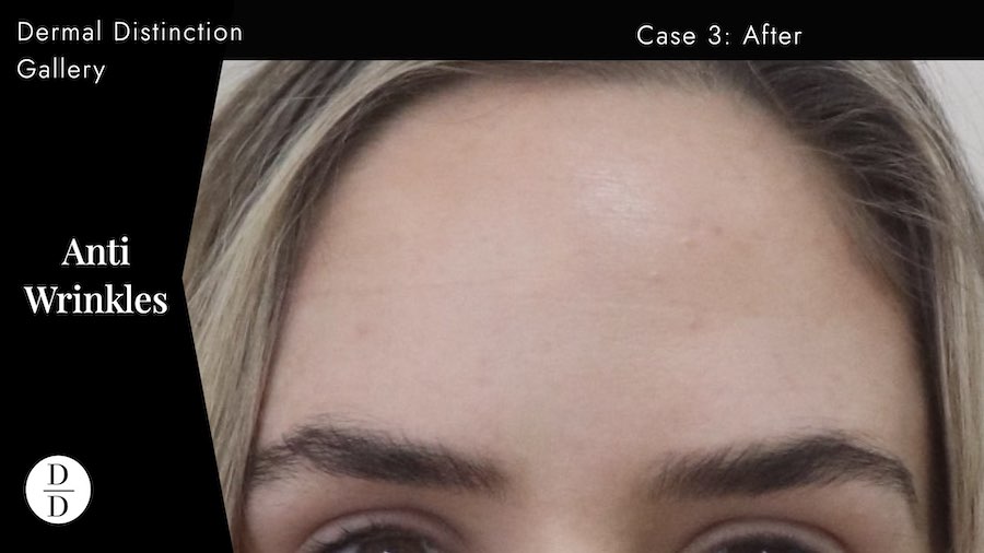 forehead wrinkle treatment melbourne