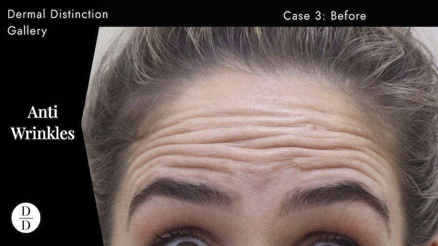 forehead wrinkle treatment melbourne before